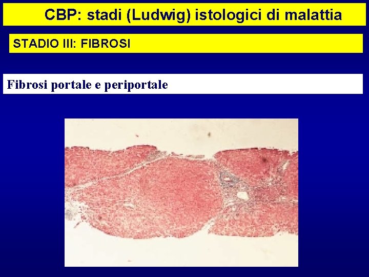 CBP: stadi (Ludwig) istologici di malattia STADIO III: FIBROSI Fibrosi portale e periportale 