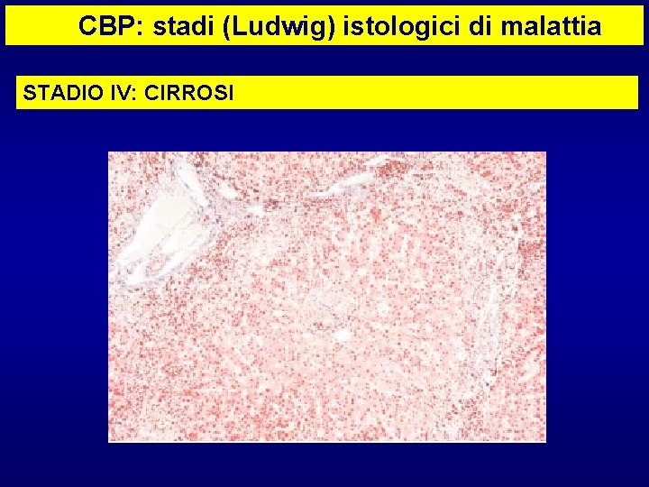 CBP: stadi (Ludwig) istologici di malattia STADIO IV: CIRROSI 