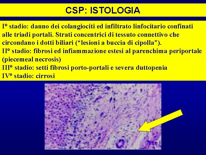 CSP: ISTOLOGIA I° stadio: danno dei colangiociti ed infiltrato linfocitario confinati alle triadi portali.