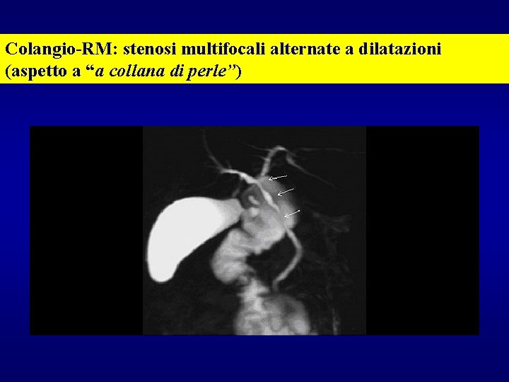 Colangio-RM: stenosi multifocali alternate a dilatazioni (aspetto a “a collana di perle”) 