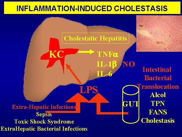 INFLAMMATION-INDUCED CHOLESTASIS Cholestatic Hepatitis KC TNF IL-1 NO Intestinal IL-6 Bacterial LPS Extra-Hepatic Infections