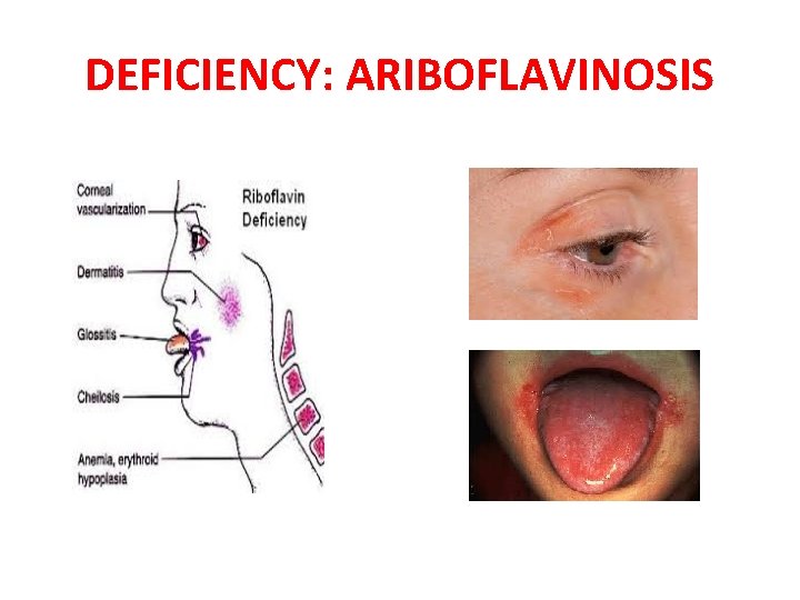 DEFICIENCY: ARIBOFLAVINOSIS 