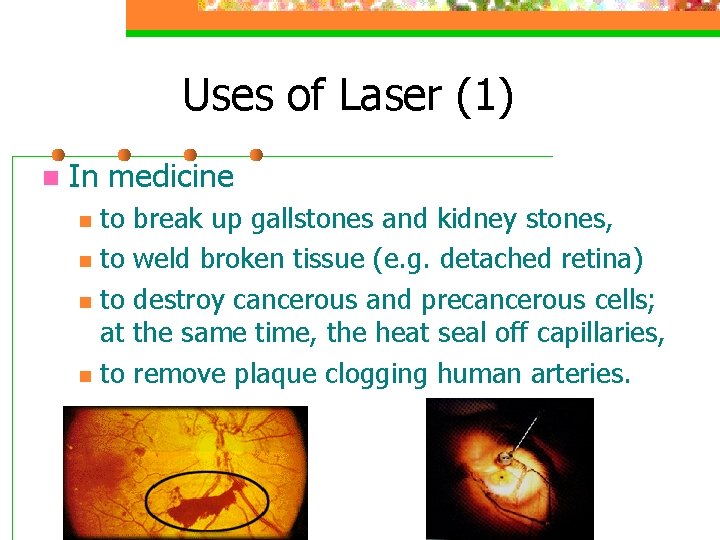 Uses of Laser (1) n In medicine n n to break up gallstones and