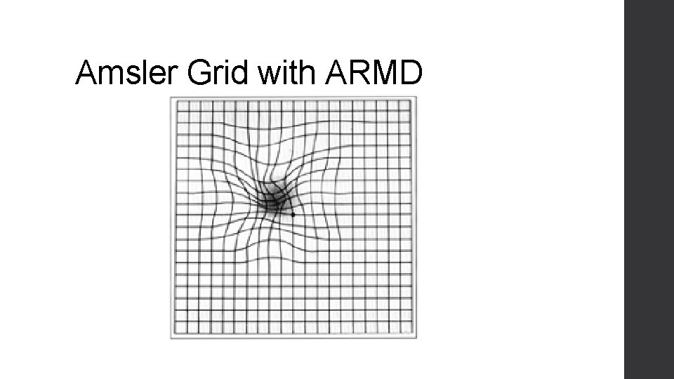 Amsler Grid with ARMD 