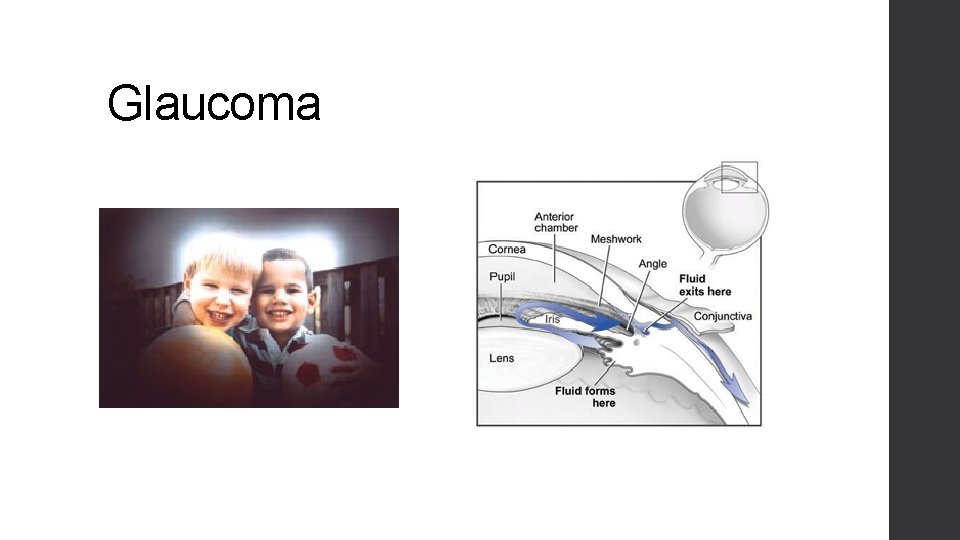 Glaucoma 