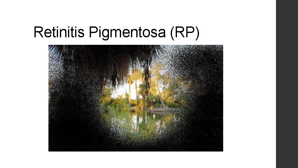 Retinitis Pigmentosa (RP) 