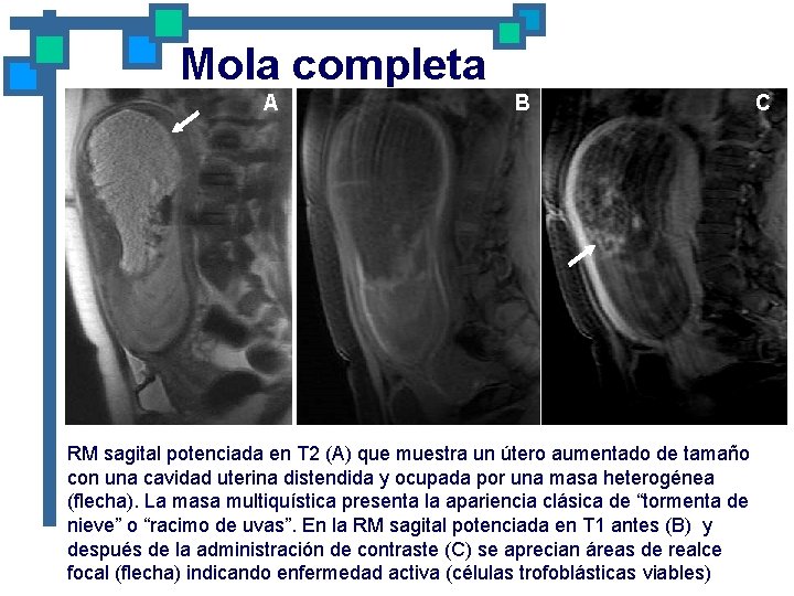 Mola completa A B RM sagital potenciada en T 2 (A) que muestra un