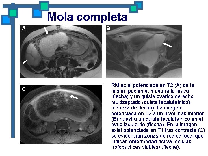 Mola completa A C B RM axial potenciada en T 2 (A) de la