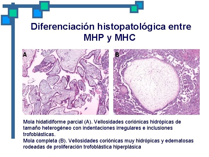 Diferenciación histopatológica entre MHP y MHC A B Mola hidatidiforme parcial (A). Vellosidades coriónicas