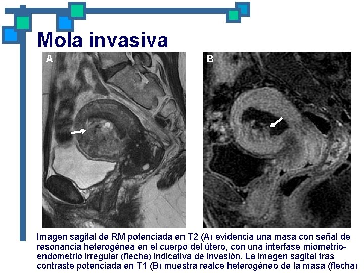 Mola invasiva A B Imagen sagital de RM potenciada en T 2 (A) evidencia