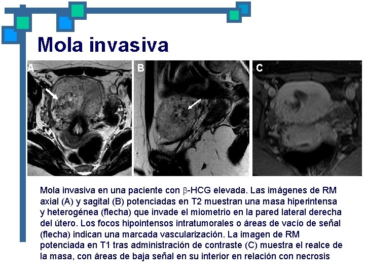 Mola invasiva A B C Mola invasiva en una paciente con -HCG elevada. Las