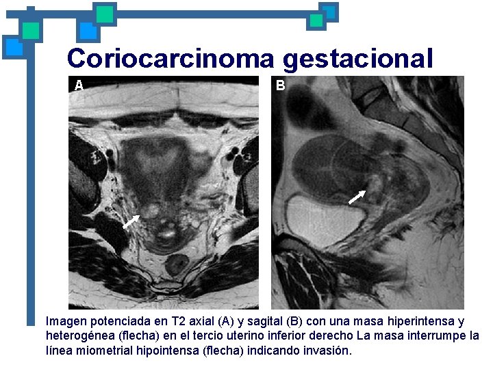 Coriocarcinoma gestacional A B Imagen potenciada en T 2 axial (A) y sagital (B)