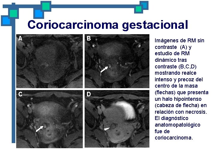Coriocarcinoma gestacional A B C D Imágenes de RM sin contraste (A) y estudio