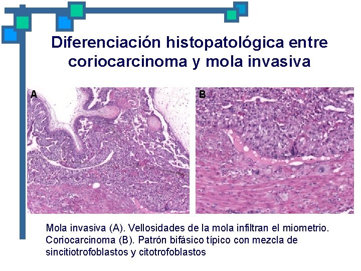 Diferenciación histopatológica entre coriocarcinoma y mola invasiva A B Mola invasiva (A). Vellosidades de