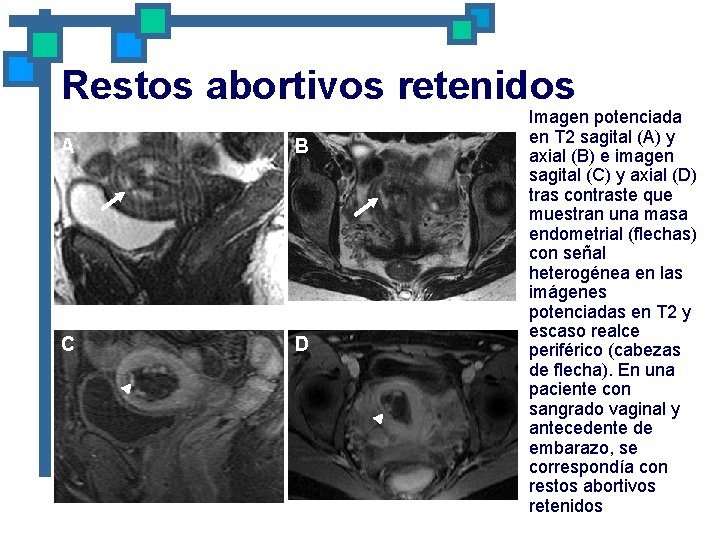 Restos abortivos retenidos A B C D Imagen potenciada en T 2 sagital (A)