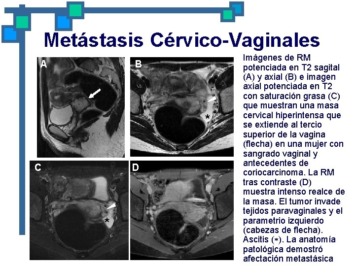 Metástasis Cérvico-Vaginales A B * C D * Imágenes de RM potenciada en T