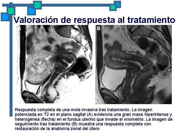 Valoración de respuesta al tratamiento A B Respuesta completa de una mola invasiva tras