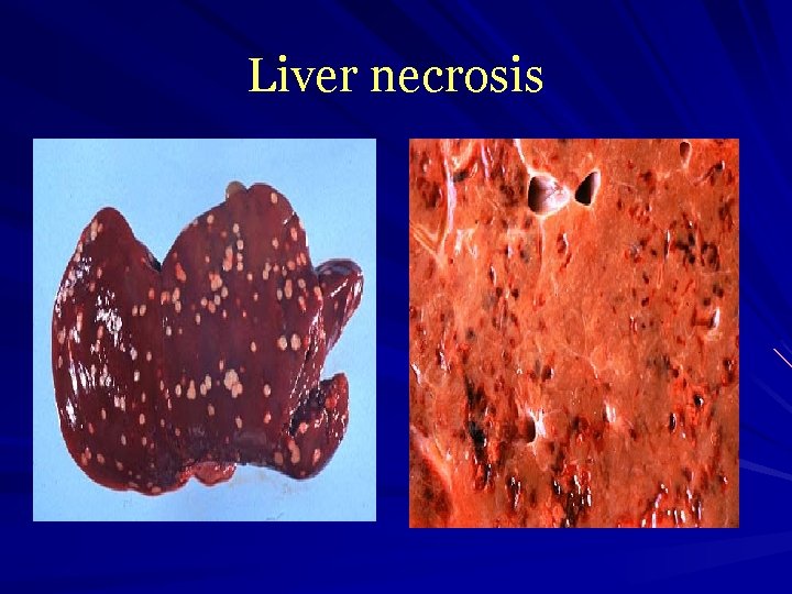 Liver necrosis 