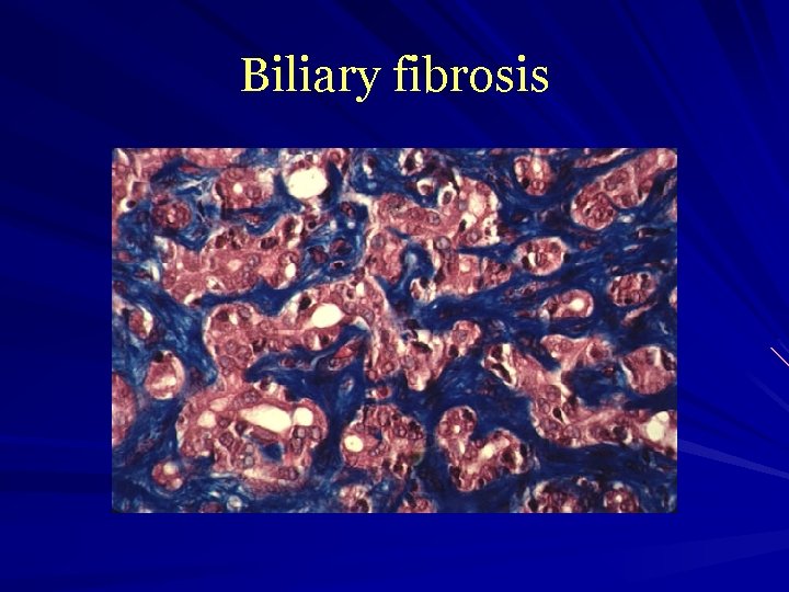 Biliary fibrosis 