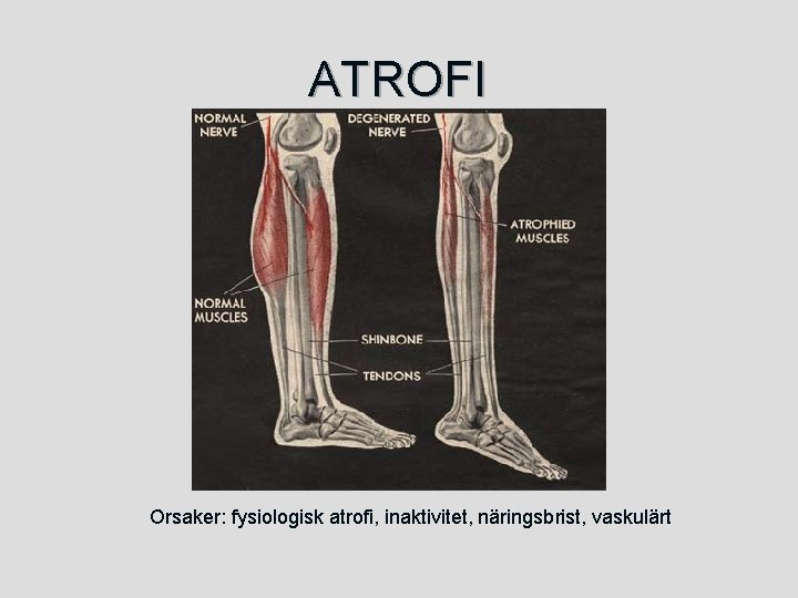 ATROFI Orsaker: fysiologisk atrofi, inaktivitet, näringsbrist, vaskulärt 