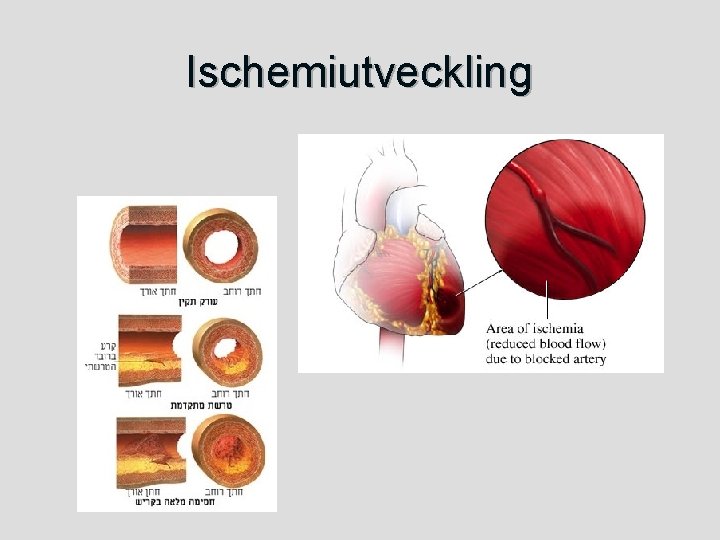 Ischemiutveckling 