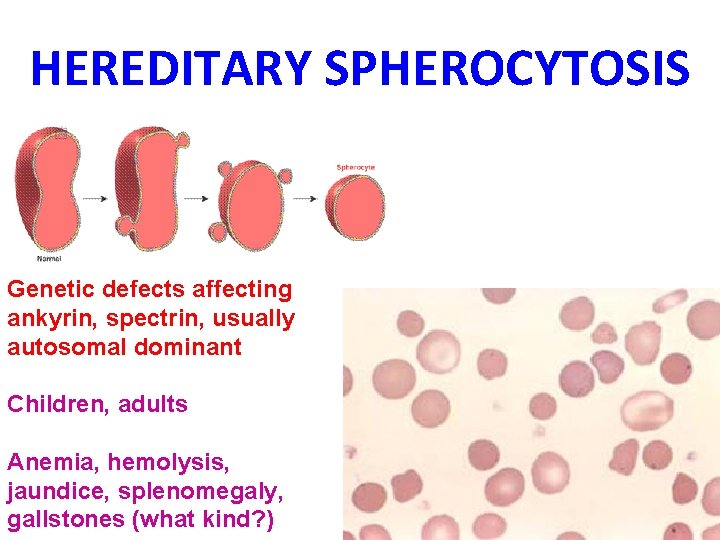 HEREDITARY SPHEROCYTOSIS Genetic defects affecting ankyrin, spectrin, usually autosomal dominant Children, adults Anemia, hemolysis,