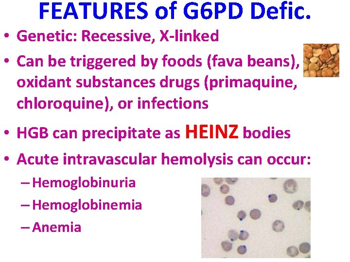 FEATURES of G 6 PD Defic. • Genetic: Recessive, X-linked • Can be triggered