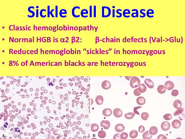 Sickle Cell Disease • • Classic hemoglobinopathy Normal HGB is α 2 β 2: