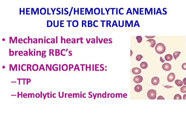 HEMOLYSIS/HEMOLYTIC ANEMIAS DUE TO RBC TRAUMA • Mechanical heart valves breaking RBC’s • MICROANGIOPATHIES: