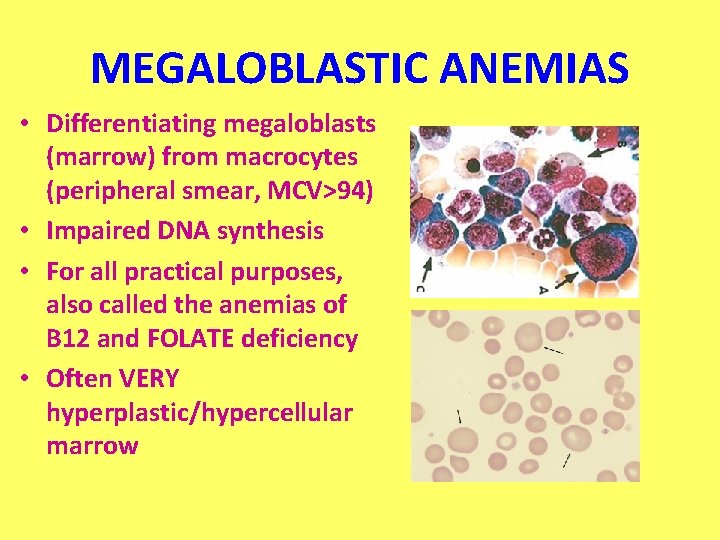 MEGALOBLASTIC ANEMIAS • Differentiating megaloblasts (marrow) from macrocytes (peripheral smear, MCV>94) • Impaired DNA