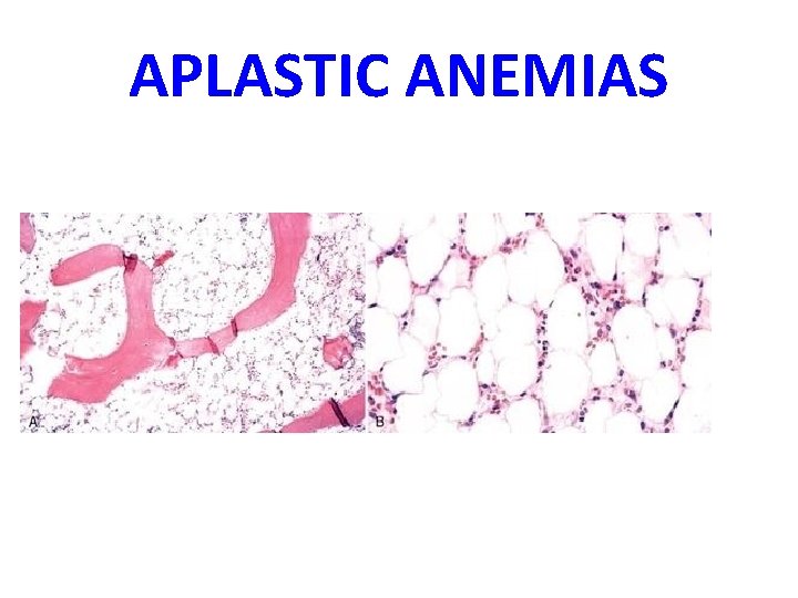 APLASTIC ANEMIAS 