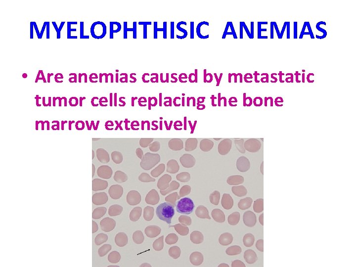 MYELOPHTHISIC ANEMIAS • Are anemias caused by metastatic tumor cells replacing the bone marrow