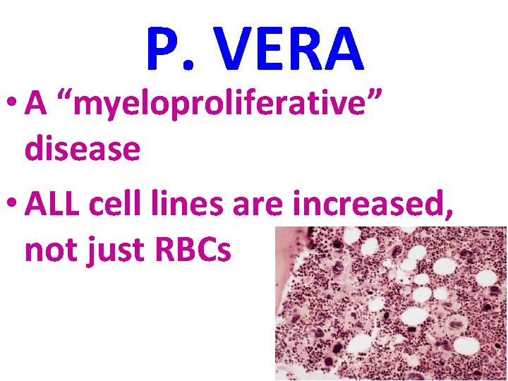 P. VERA • A “myeloproliferative” disease • ALL cell lines are increased, not just