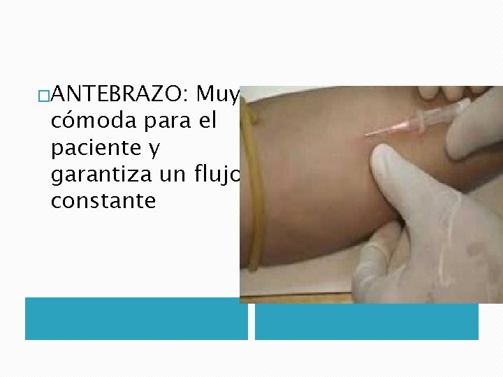 �ANTEBRAZO: Muy cómoda para el paciente y garantiza un flujo constante �ANTEBRAZO: Muy cómoda para el paciente y garantiza un flujo constante