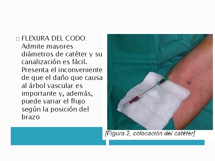 � FLEXURA DEL CODO: Admite mayores diámetros de catéter y su canalización es fácil. � FLEXURA DEL CODO: Admite mayores diámetros de catéter y su canalización es fácil.