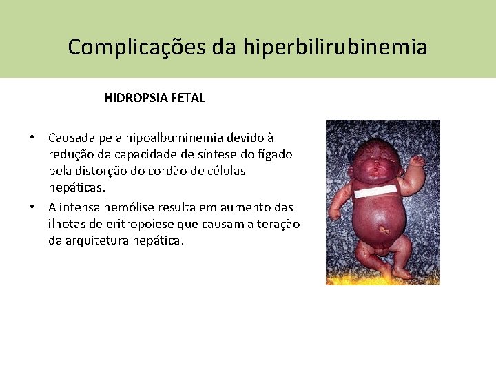 Complicações da hiperbilirubinemia HIDROPSIA FETAL • Causada pela hipoalbuminemia devido à redução da capacidade