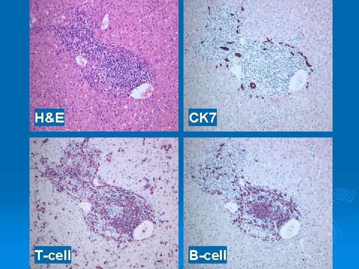 H&E CK 7 T-cell B-cell 