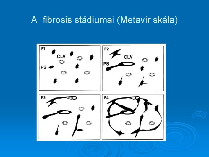 A fibrosis stádiumai (Metavir skála) 