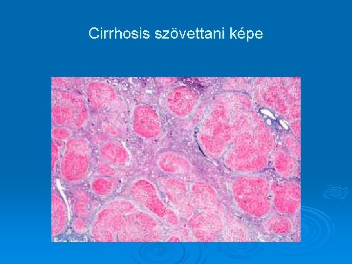 Cirrhosis szövettani képe 