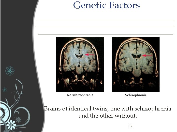 Genetic Factors _______________________________________________ Brains of identical twins, one with schizophrenia and the other without.