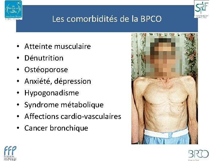 Les comorbidités de la BPCO • • Atteinte musculaire Dénutrition Ostéoporose Anxiété, dépression Hypogonadisme