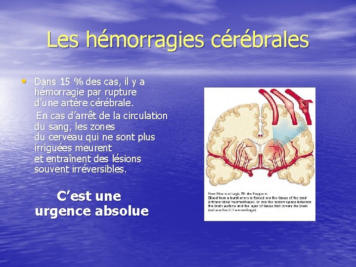 Les hémorragies cérébrales • Dans 15 % des cas, il y a hémorragie par