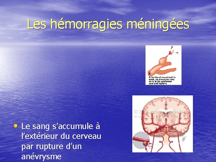 Les hémorragies méningées • Le sang s’accumule à l’extérieur du cerveau par rupture d’un