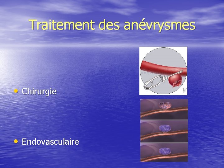Traitement des anévrysmes • Chirurgie • Endovasculaire 
