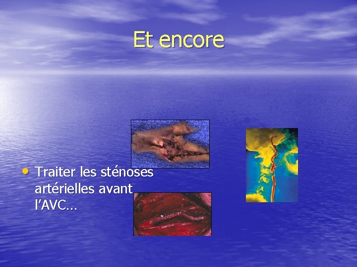 Et encore • Traiter les sténoses artérielles avant l’AVC… 