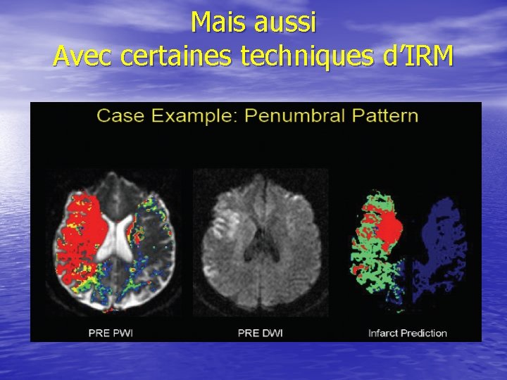 Mais aussi Avec certaines techniques d’IRM 