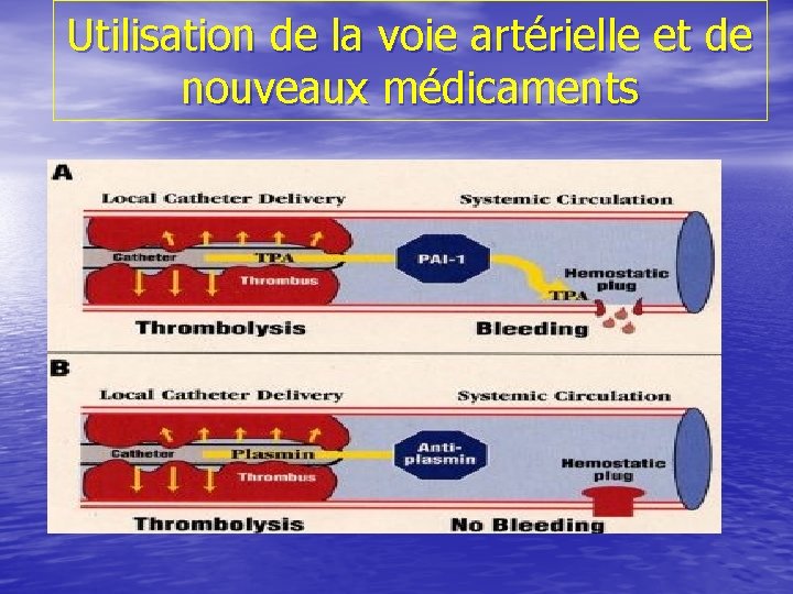 Utilisation de la voie artérielle et de nouveaux médicaments 