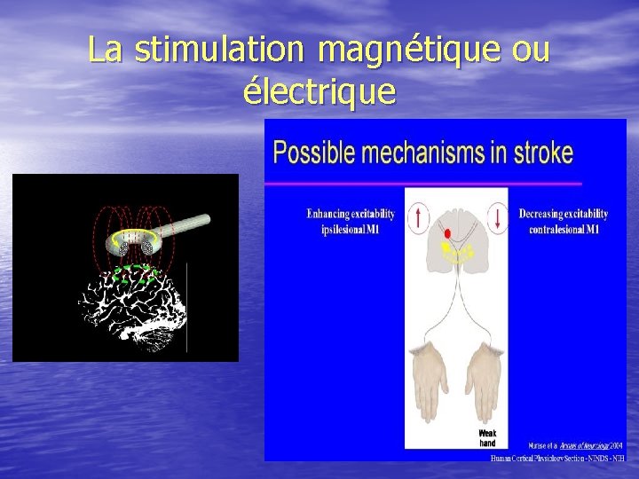 La stimulation magnétique ou électrique 