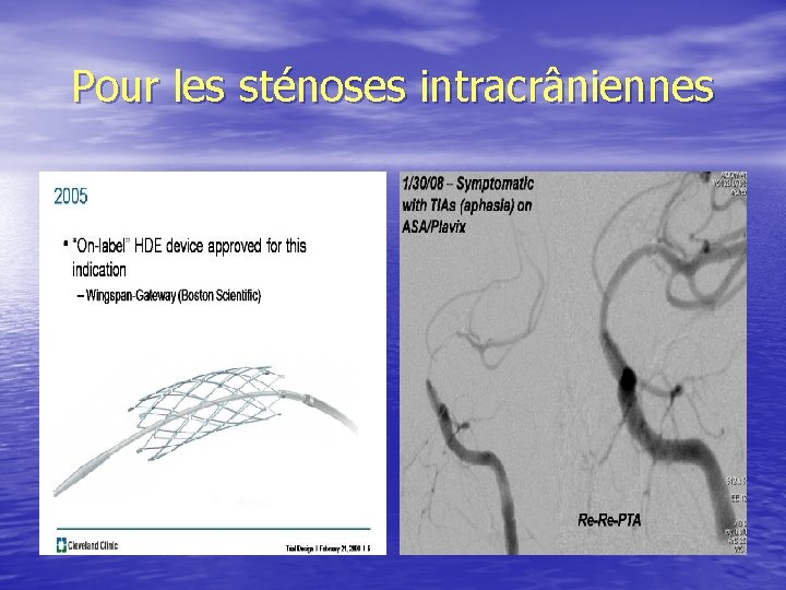 Pour les sténoses intracrâniennes 