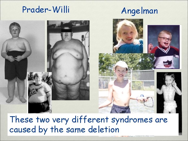 Prader-Willi Angelman These two very different syndromes are caused by the same deletion 